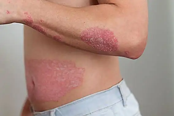 psoriasis pustulosa leve